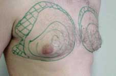 Fettabsaugung Brust Minden